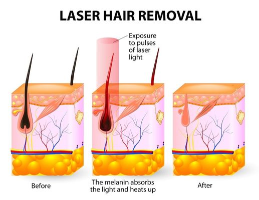 Macchina di depilazione del laser a diodi del salone 20HZ 808 della stazione termale