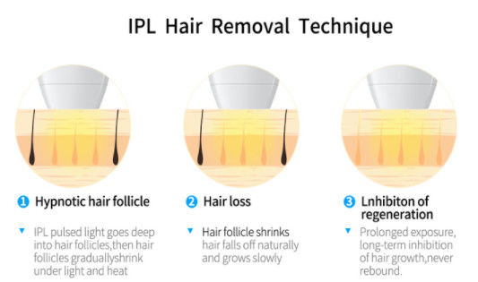 2000w tecnologia del LASER A DIODI dell'OPT IPL+ 808NM per l'attrezzatura di depilazione